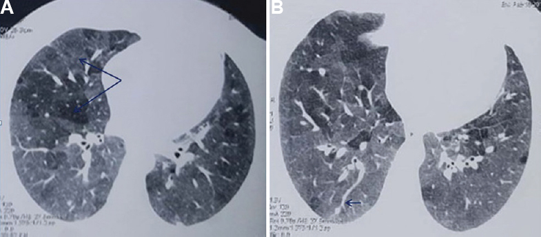High-resolution computed tomography of chest axial section at the level of lower lobe bronchus. (A) Shows head-cheese sign (arrows) and (B) showing feeding vessel sign (arrow).
